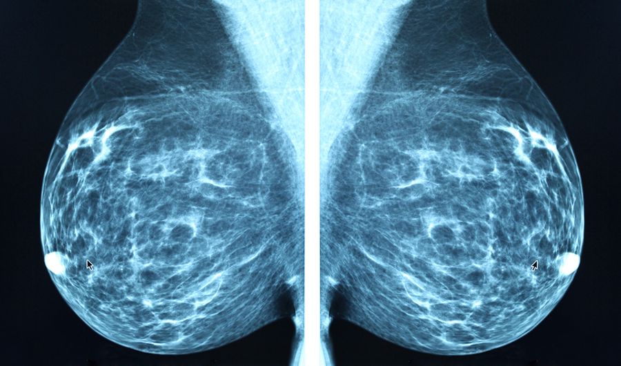 Rak piersi mammografia
