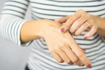 bliznowiec na dłoni - czy bliznowce są niebezpieczne